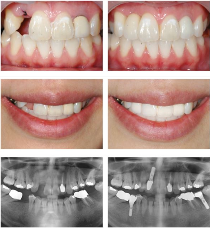 65세 이상 건강보험 임플란트 적용 조건