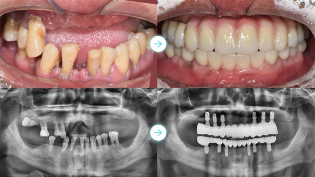 임플란트 가격 구조와 구성 요소