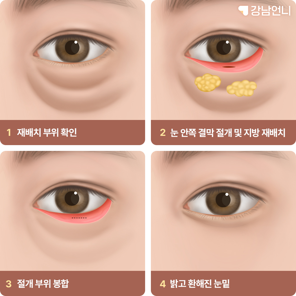 눈밑지방재배치 시술 방식 이해하기