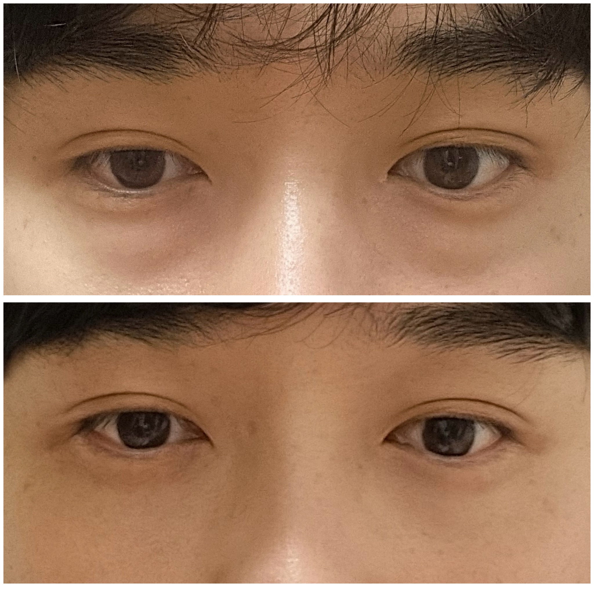 눈밑지방재배치 수술비용과 회복기간 정리